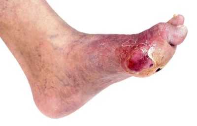 Диабетическая нога - лечение и причины ран на ногах при сахарном диабете