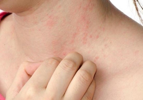 Аллергическая сыпь на теле