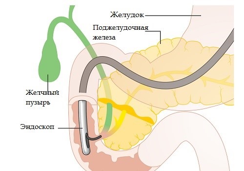 Эндоскопическая сфинктеротомия