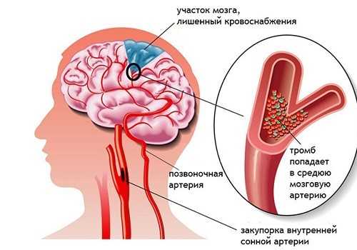 тромб в головном мозге