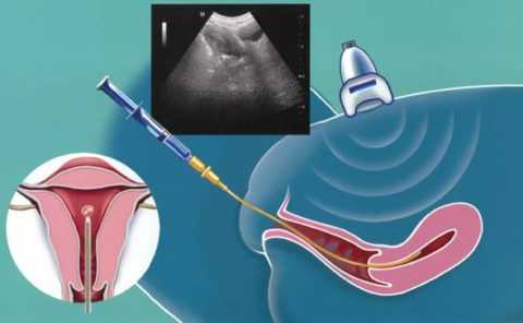 Перенос эмбриона в полость матки