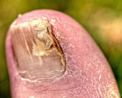 Поражение ногтевой пластины грибком