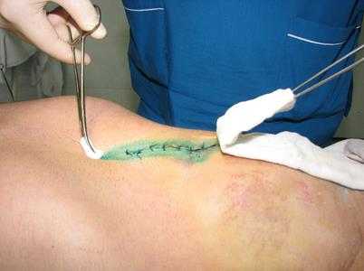 При хирургической обработке важно соблюдение правил асептики и антисептики