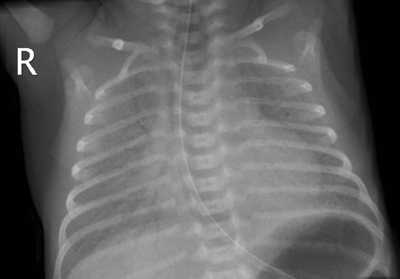 Рентгенологическая картина легких