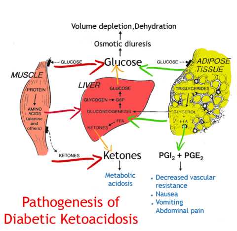 Схематическое изображение ДКА – острого осложнения сахарного диабета.