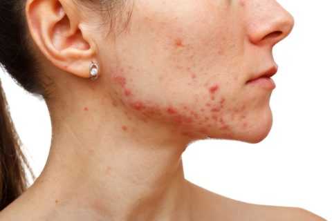 Сыпь и волосы на лице указывают на расстройства гормонального фона.