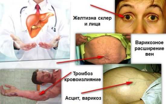 Признаки цирроза