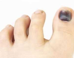 Чернеют ноги и ногти на ногах при диабете